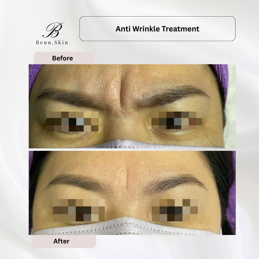Anti-wrinkle-treatment