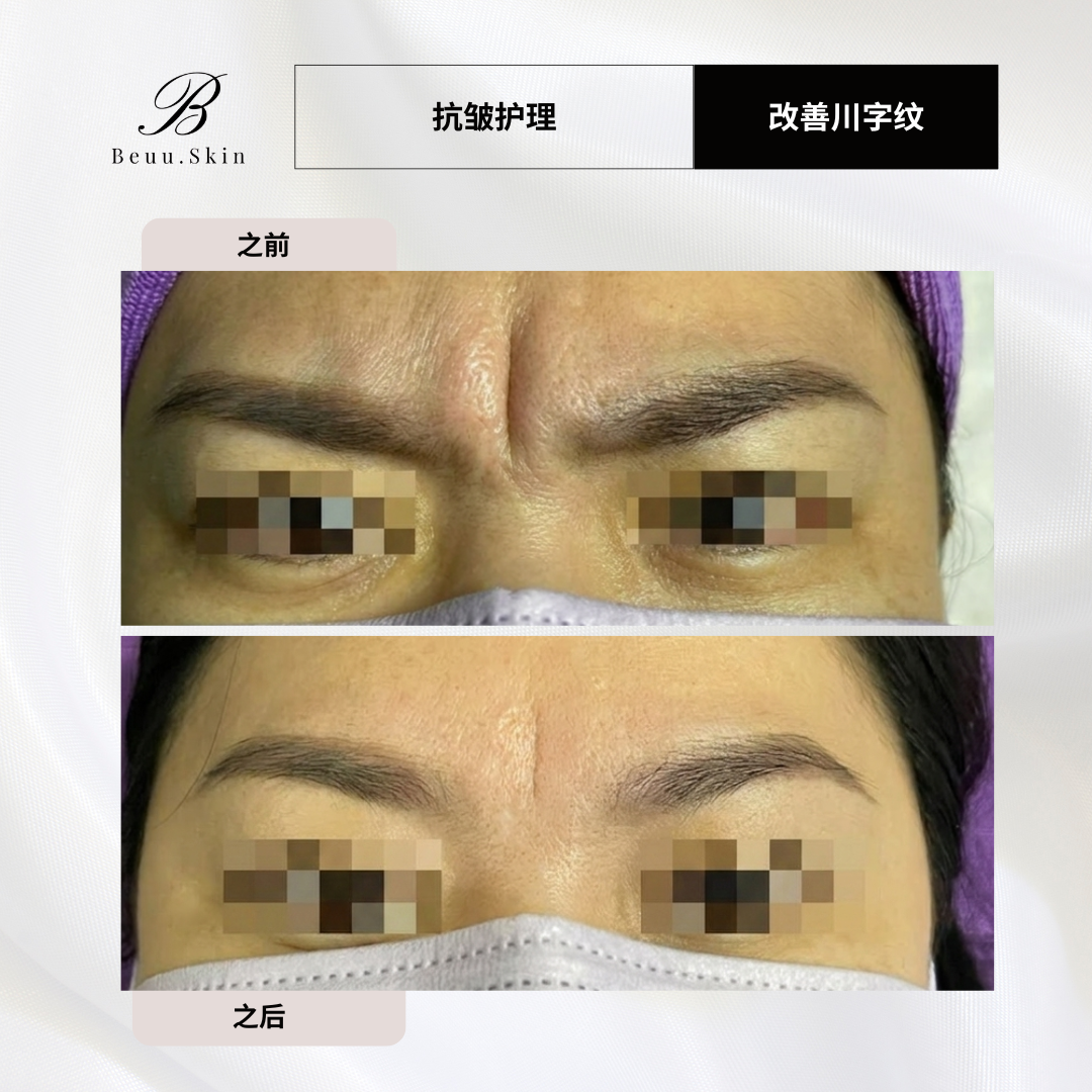 anti-wrinkle-treatment