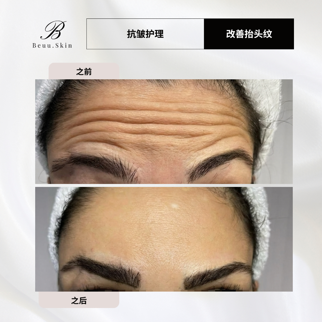 Anti Wrinkle Treatment